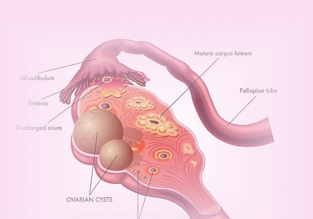 Ovarian Cysts : London Obs and Gynae Clinic Harley Street